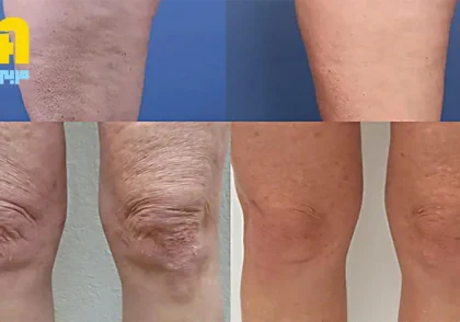 چگونه از شر سلولیت خلاص شویم؟ روش‌های مؤثر برای کاهش سلولیت