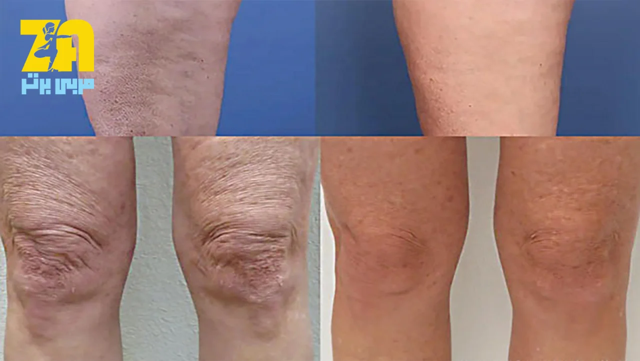 چگونه از شر سلولیت خلاص شویم؟ روش‌های مؤثر برای کاهش سلولیت