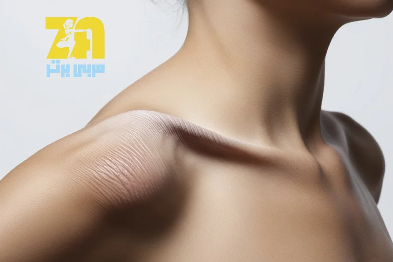 stretch marks-morabibartar